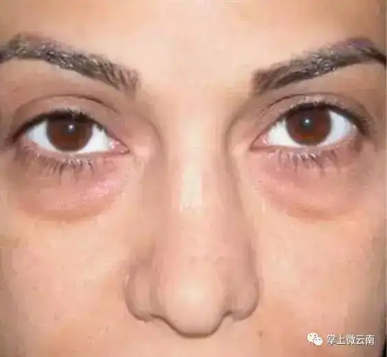 还花钱买什么眼霜呀一个鸡蛋就能消除眼袋