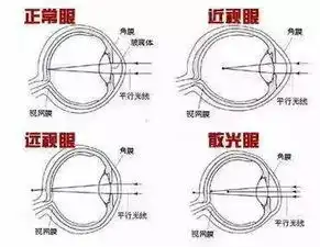 近视困扰了近一半的中国人,矫正手法值得一学