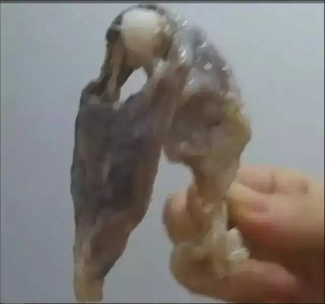 妇科医院流出的子宫垃圾照片,太恶心了子宫居然这么脏图片慎点