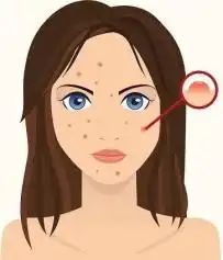 多囊卵巢综合征女性健康隐形杀手