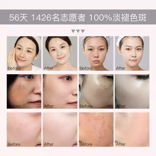 中国祛斑十大名牌,告别色斑,重拾自信