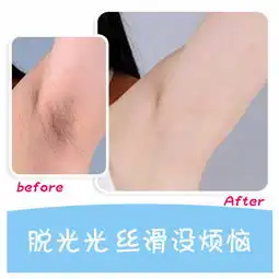 激光脱毛冰点腋下脱毛一年12次快捷舒适纵向丝滑让你举手不在尴尬悦美整形
