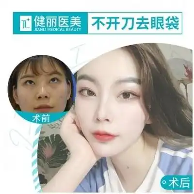祛眼袋健丽专注25年不开刀去眼袋20分钟一次消除下单即送美白嫩肤悦美整形