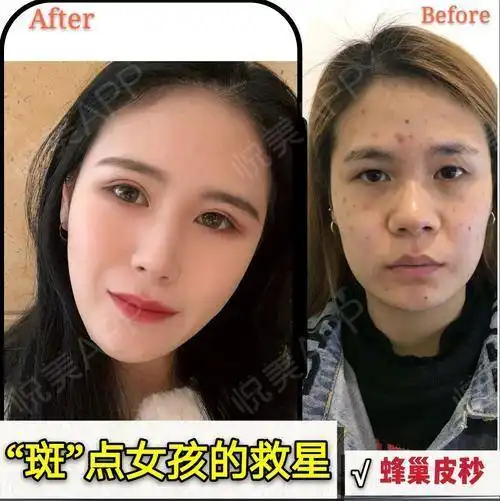 我这个万年大斑脸呐,平时...祛斑悦美整形